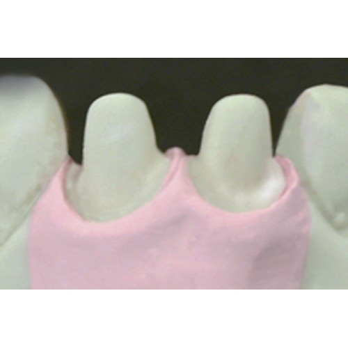 Dreve GumQuick implant Gingival Mask Material