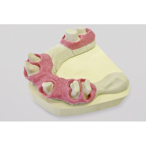 Dreve GumQuick implant Gingival Mask Material