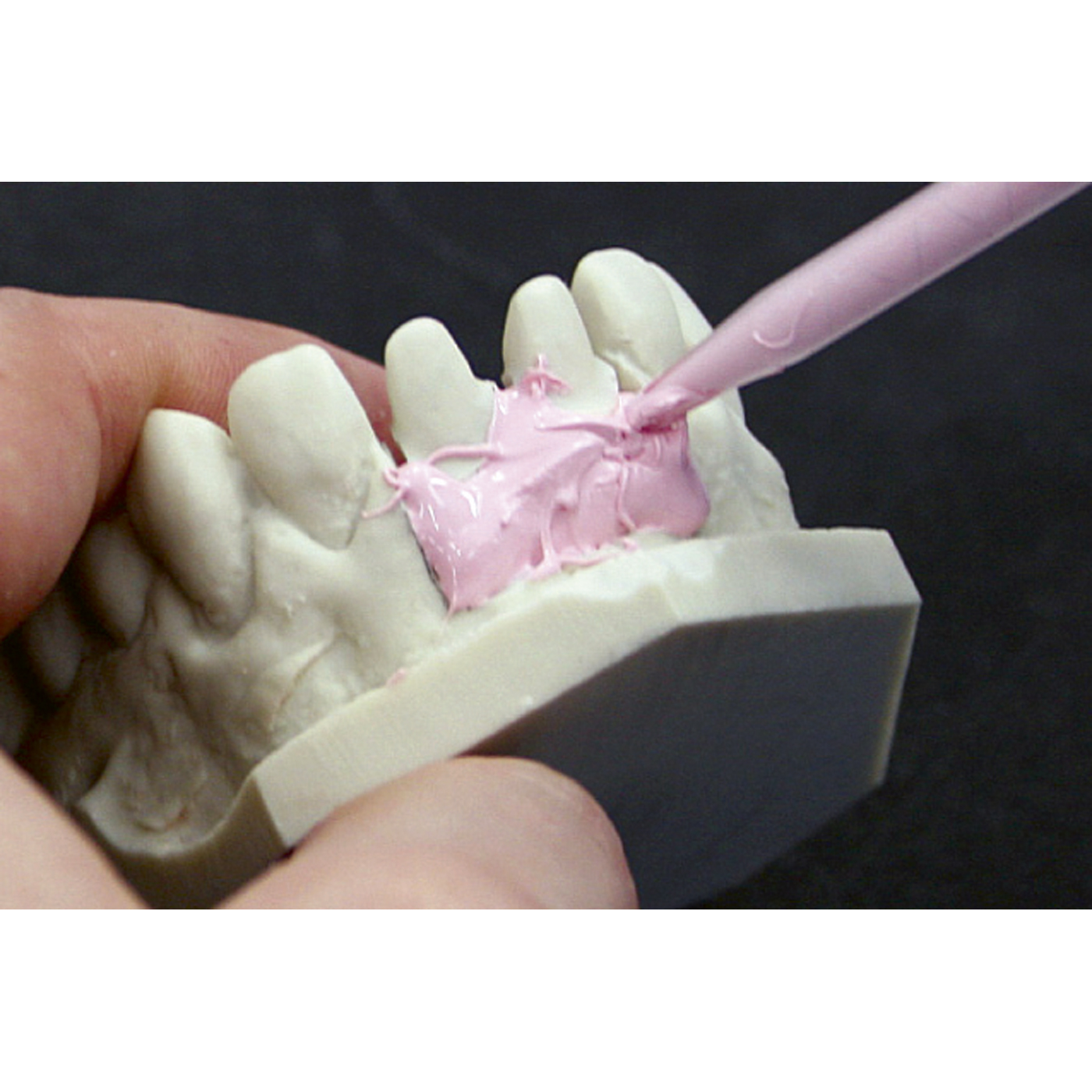 Dreve GumQuick implant Gingival Mask Material