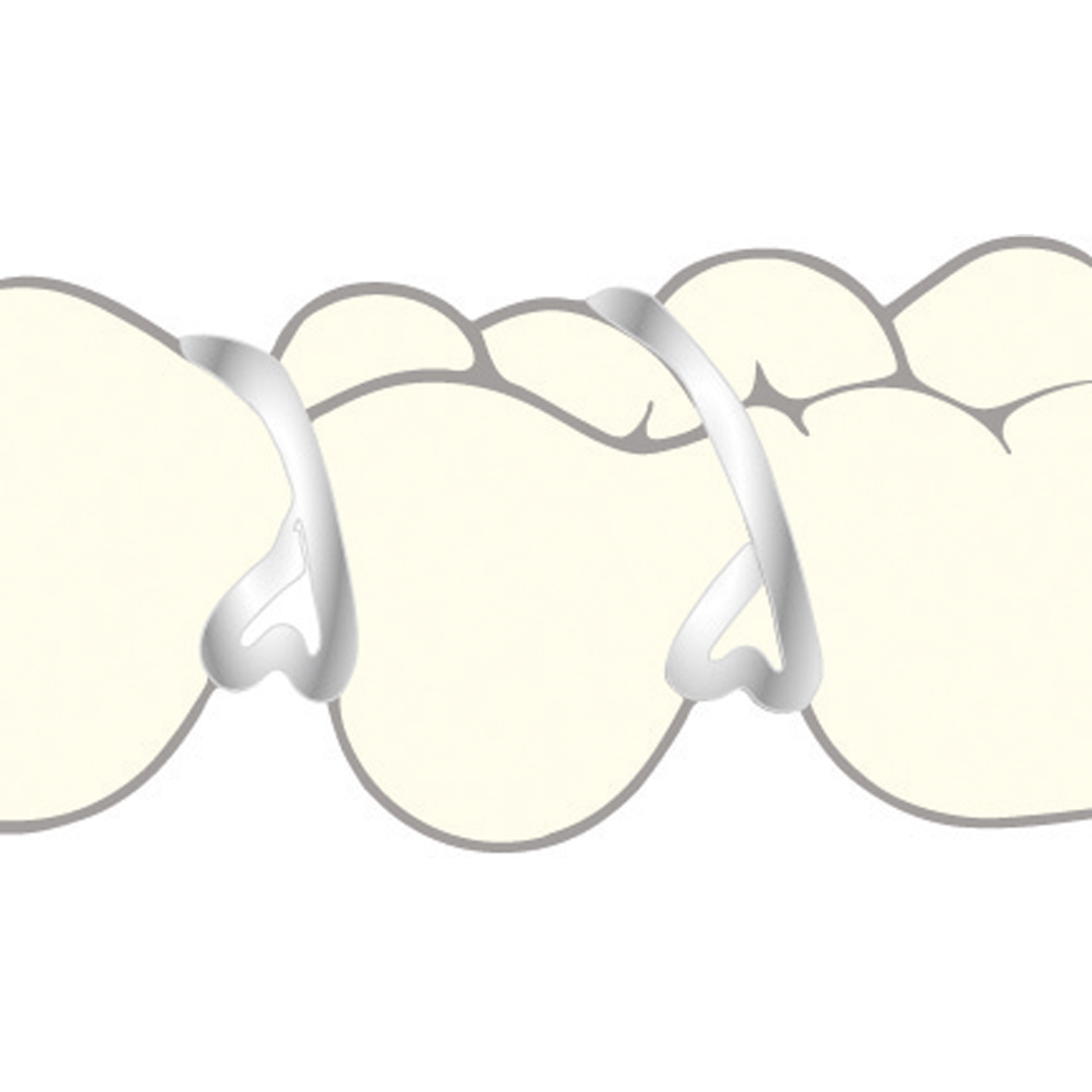 ScheuDental Triangular Clasps, 0.8 mm